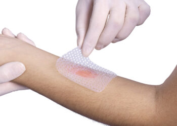 Primeiros Socorros em caso de queimadura de 2º grau