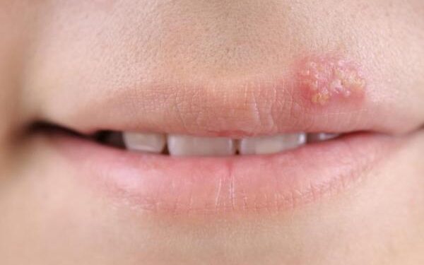 O que pode aumentar o risco de desenvolver Herpes Simples?