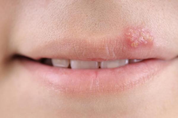 O que pode aumentar o risco de desenvolver Herpes Simples?